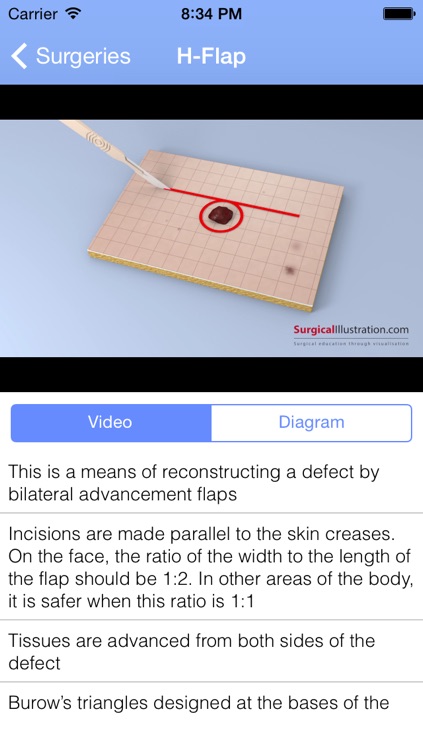 Surgical Flaps