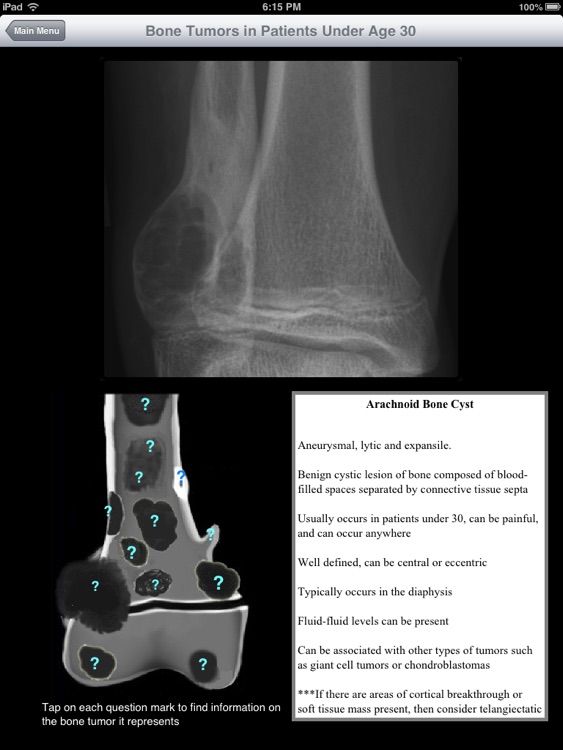 iMSK Bone Tumors