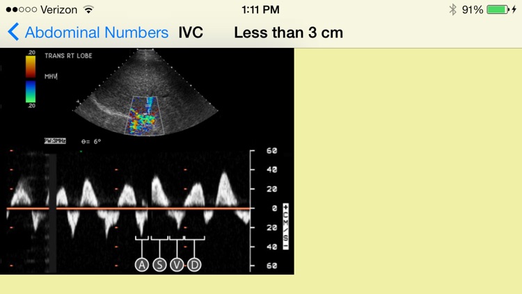 Sonograpy Cheat Sheet: Abdominal