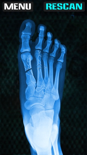 Xray Fracture Foot Prank(圖2)-速報App