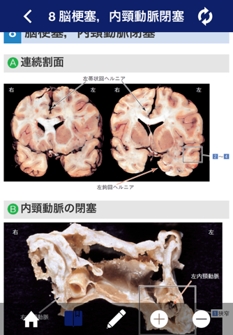 ATLAS OF PATHOLOGY And Comparison With Normal Anatomy Lite screenshot 2