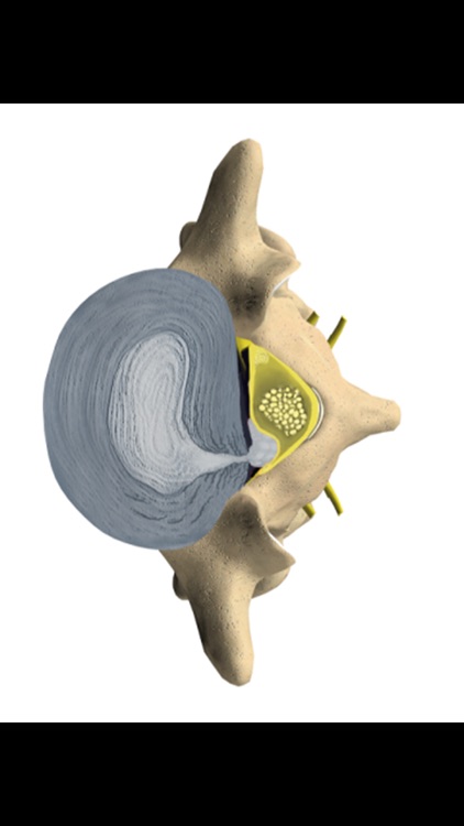mLumbarDiscHerniation