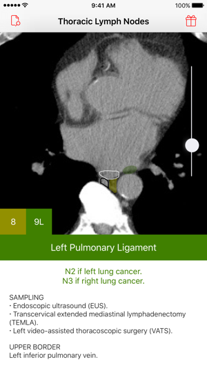 Thoracic Lymph Node Map(圖1)-速報App