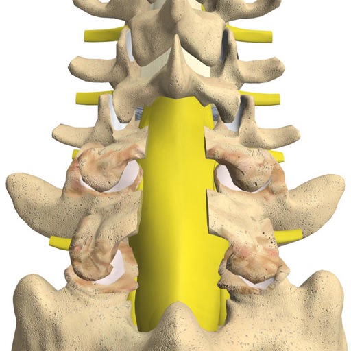 mLumbarLaminectomy