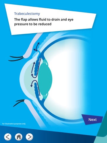 Glaucoma in perspective HCP UK screenshot 3