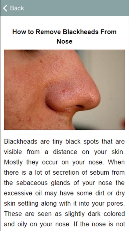 How To Remove Blackheads