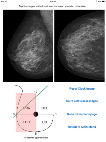 Mammography Localizer screenshot 3