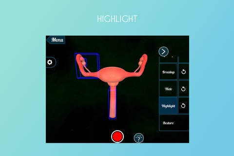 Tubectomy 3D screenshot 3