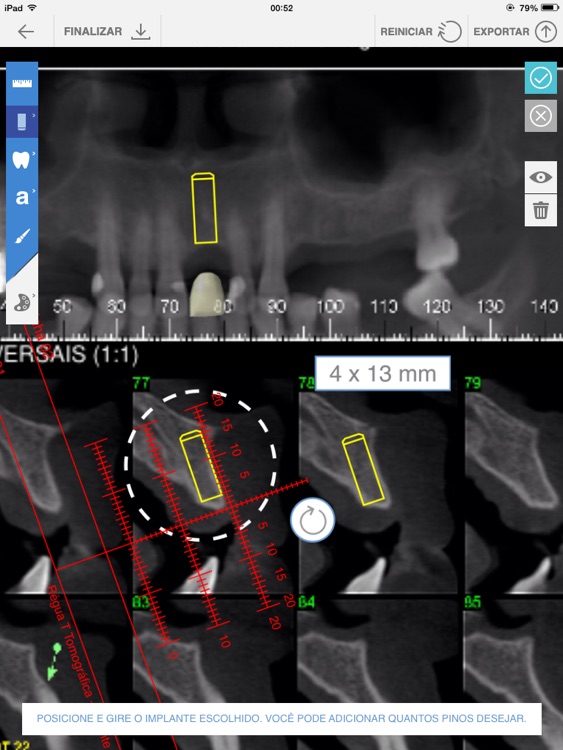 Implant for iPad