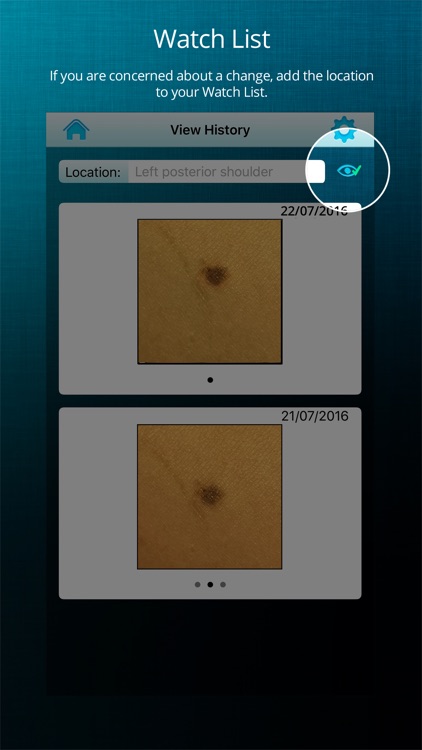ApreSkin you - track your moles, skin cancers / melanoma and blemishes screenshot-4