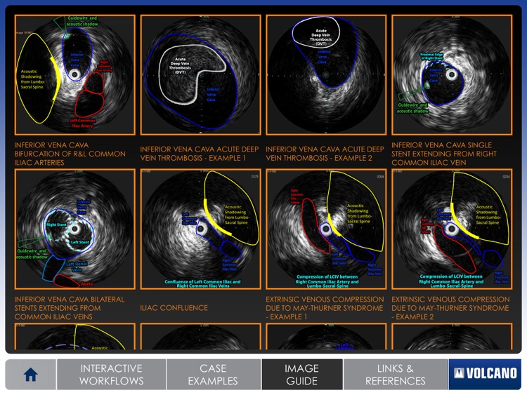 Venous IVUS screenshot-4