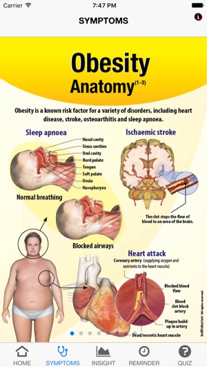 Signs & Symptoms Obesity(圖2)-速報App