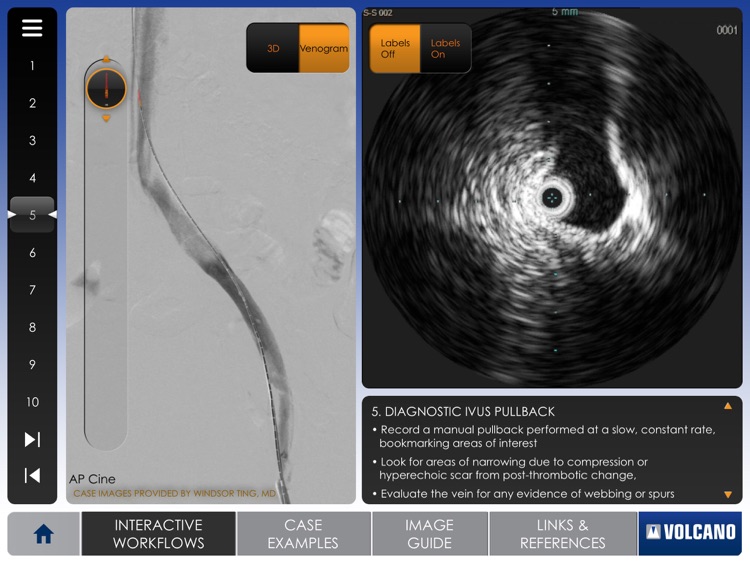 Venous IVUS