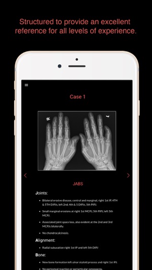 ESIMR: Uncovering The Hand Radiograph(圖2)-速報App