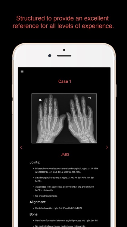 ESIMR: Uncovering The Hand Radiograph