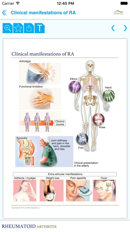 Rheumatoid arthritis Miniatlas screenshot-3