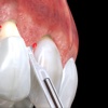 Periodontal Advanced Surgery By Mariano Sanz