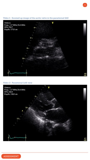 Ultrasound