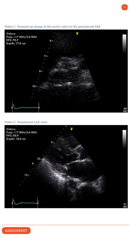 Ultrasound