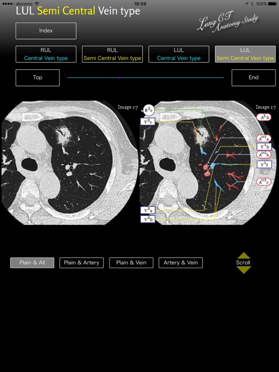 Lung CT Anatomy STUDY screenshot-4