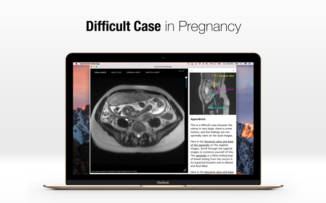 Appendicitis Radiology(圖1)-速報App