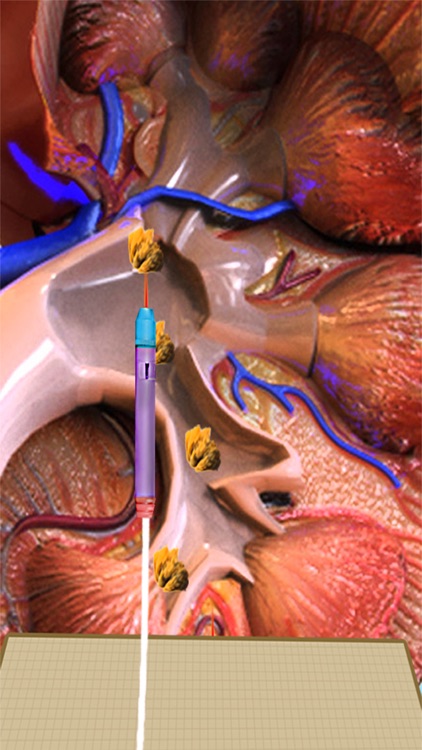 Kidney Laser Surgery