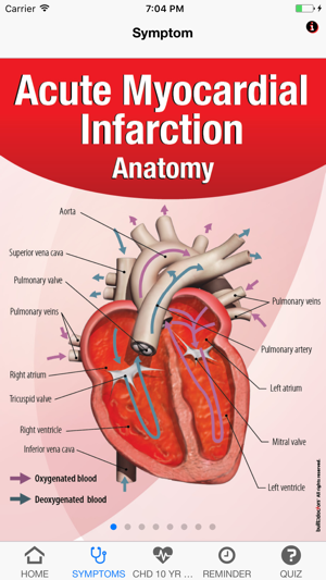 Signs & Symptoms Acute Myocardial Infarction(圖2)-速報App