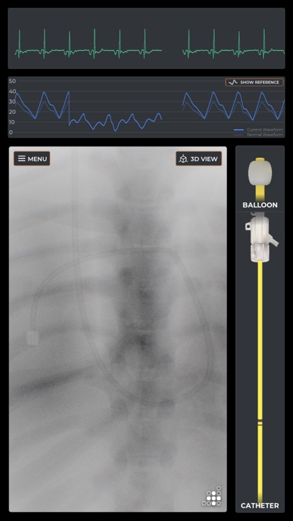 Mentice Right Heart Cath