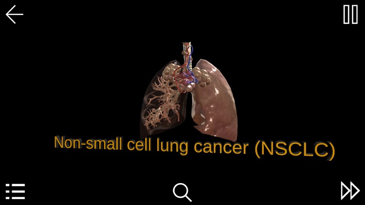 Non-Small-Cell Lung Cancer