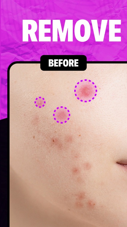 Remove Object & Erase Pimples screenshot-4