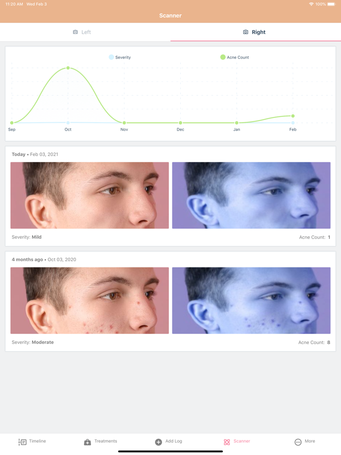 AcneLog Acne Healing Tracker