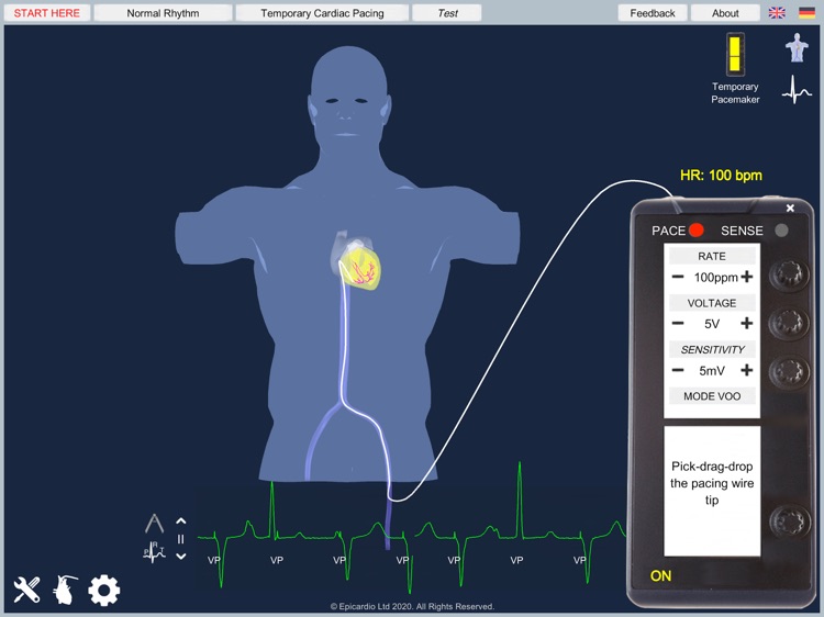 Temporary Cardiac Pacing