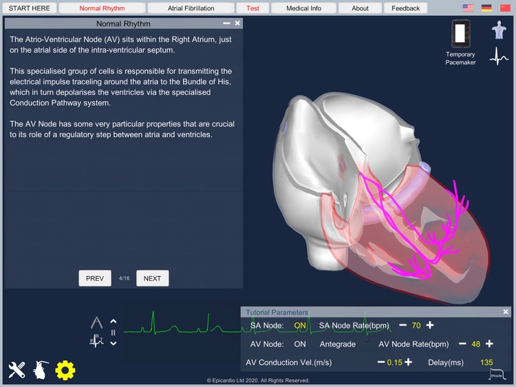 Atrial Fibrillation screenshot-5