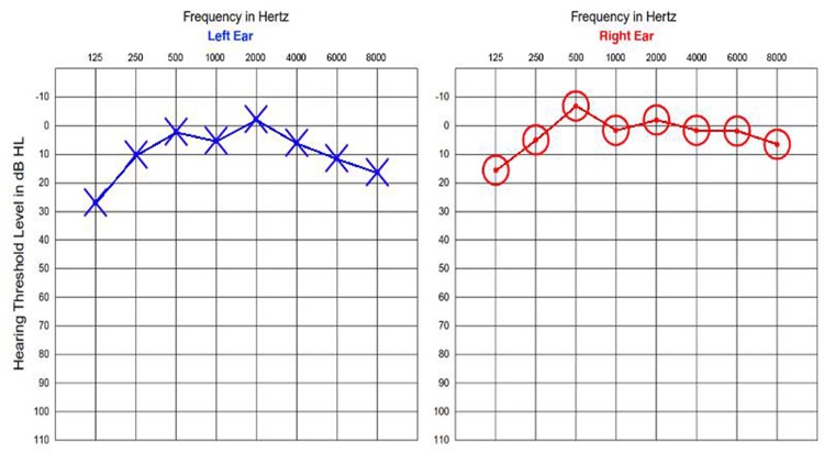 Audiogram Hearing Test