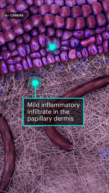 Actinic Keratosis AR screenshot-3